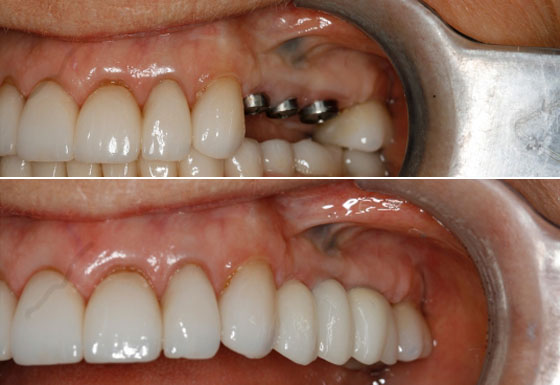 Dental Denture in Trivandrum Kerala