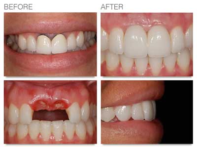 Prosthodontics Trivandrum Kerala