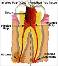 Pulpotomy Treatment Trivandrum Kerala